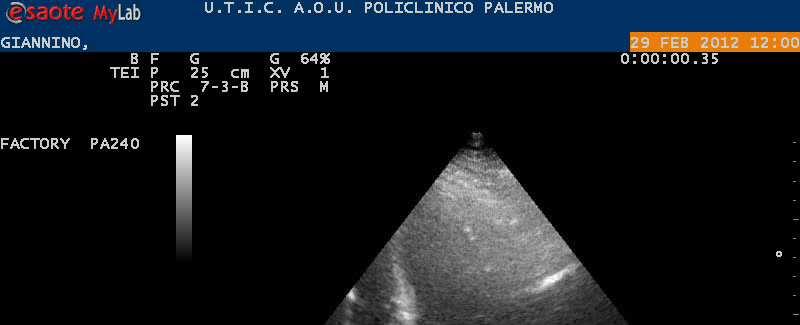 Ecocardiogramma Ventricolo sn dilatato con spessori di parete aumentati; ipocinesia