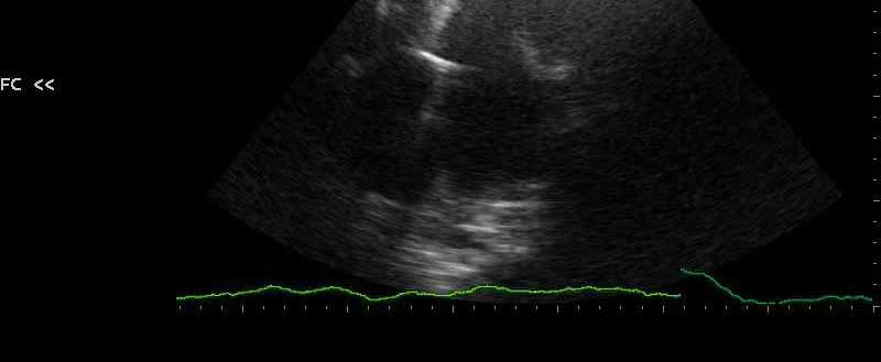 aorta ascendente; atrio sn dilatato; sezioni destre dilatate con funzione ventricolare dx