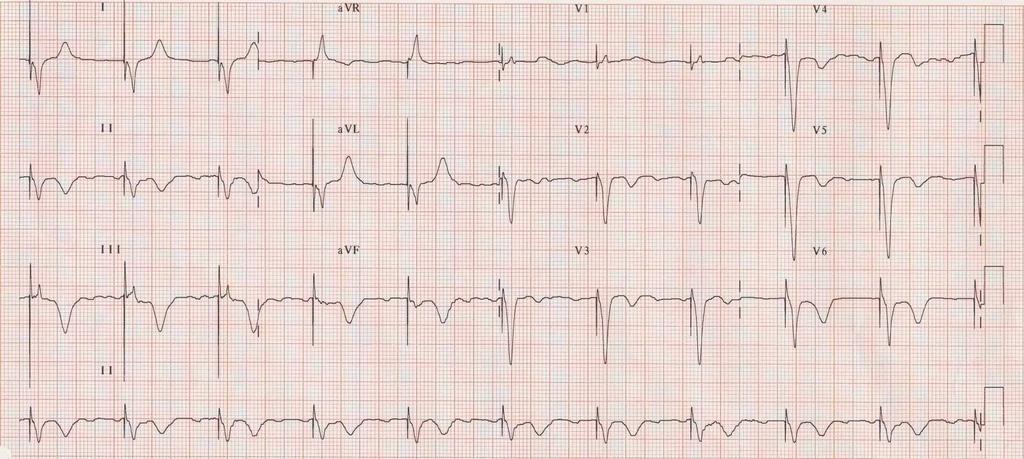 ECG pre-impianto