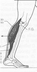 iper-attivo) impedisce la flessione dorsale del calcagno, può intervenire