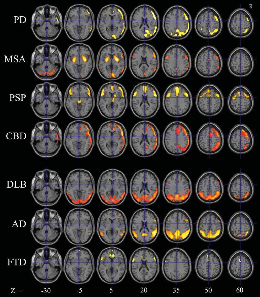 Teune et al., Mov Disord 2010 D.