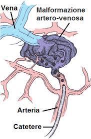 Embolizzazione Microcateterizzazione e iniezione di enbucrilato al 66% nei 2 rami principali della MAV (residuo 5-10%). STOP tp cardiologica a 48 ore.