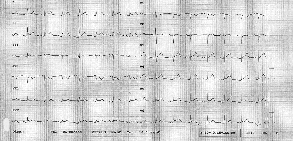 DIAGNOSI ECOCARDIOGRAFICA DI SINDROME AORTICA ACUTA IN PRONTO SOCCORSO Figura 1.