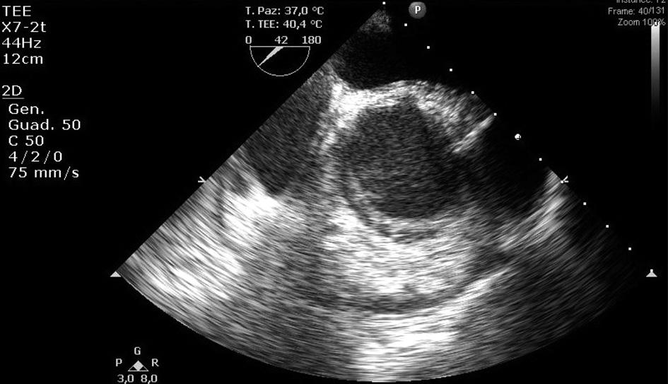 intramurale e con evidenza, a circa 5 cm dal piano valvolare aortico, di una escavazione della parete a forma di cratere a margini regolari, riferibile a ulcera penetrante della parete aortica.