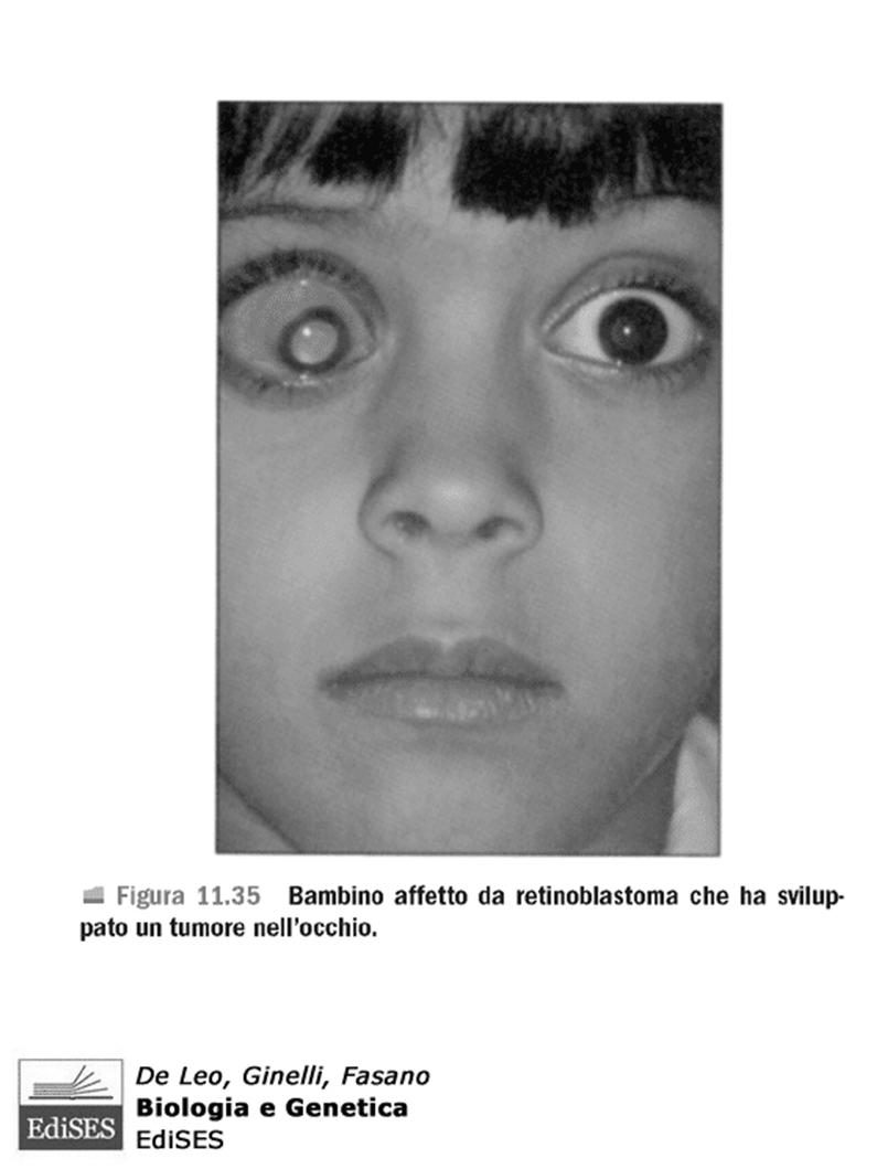 Alcune malattie umane derivano da delezioni cromosomiche Es retinoblastoma può