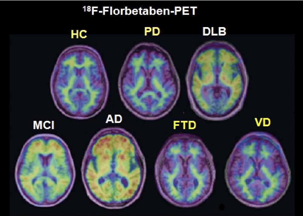 Compilazione del «Radiopharmacy data form» e preparazione delle dosi per i pazienti reclutati per lo studio [ 18 F]Florbetapir: un radiofarmaco-pet non oncologico FDA ha approvato l uso di Amyvid per