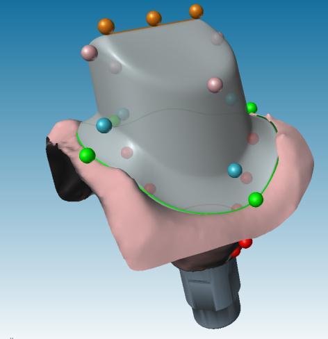 1.4.1 Moncone personalizzato Creare la linea di margine sotto/sopra gengivale Utilizzando la disattivazione Abutment Parallel to