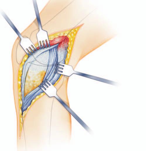 Tecnica chirurgica 3 Determinazione della posizione della placca Servendosi di marcatori anatomici e della fluoroscopia, montare la placca sul piatto