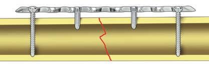 Giusto Importante: se si utilizza una combinazione di viti da corticale (1) e di bloccaggio (2), inserire prima una vite da corticale per premere la placca sull osso.