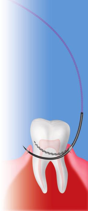 AGHI DA VISI-BLACK I primi aghi neri a curvatura composta per Chirurgia Odontoiatrica Gli aghi DA permettono al chirurgo un agevole utilizzo grazie alla loro esclusiva geometria.