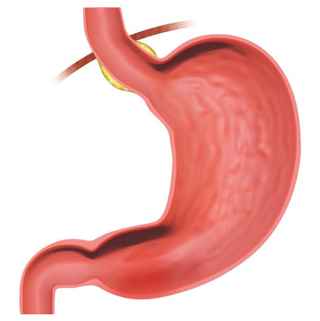«Disturbi gastro-intestinali» 15 Che cosa significa reflusso?