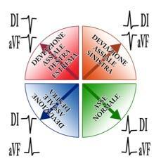 Valutare l asse elettrico cardiaco: a. Altro elemento importante da valutare nella lettura di un ECG, esso indica la direzione dell ansa vettoriale di depolarizzazione dell intero muscolo miocardico.