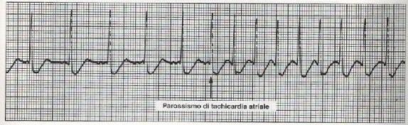 Complesso QRS: di aspetto normale, ciascuno di essi segue un onda P Intervallo QRS: 0.04 0.08 secondi. Onda T: segue ciascun complesso QRS ed è positiva.