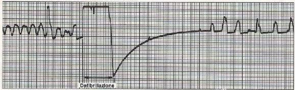 Fibrillazione ventricolare: Frequenza: non è misurabile data l assenza di complessi QRS ben formati. Ritmo: caotico. Onda P: assente. Intervallo P-R: non misurabile.