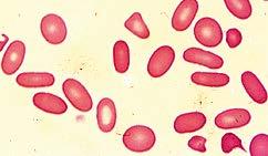 Principali caratteristiche dello striscio periferico nelle diverse forme di anemia.