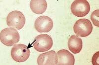 La modifica di uno o più di questi elementi determinerà un quadro clinico di anemia, una volta superati i meccanismi di compenso dell organismo.