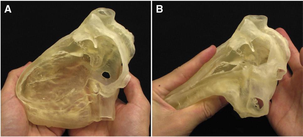 Cuore: malattie cardiache strutturali (2) Stampa di modelli flessibili Material jetting Stampanti della linea Objet (Stratasys) + materiale TangoPlus Modello funzionale Utili per simulazioni di