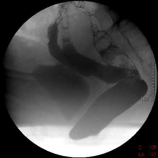 Defecografia: documentazione radiologica della regione ano-rettale, del piano pelvico-perineale e delle alterazioni della