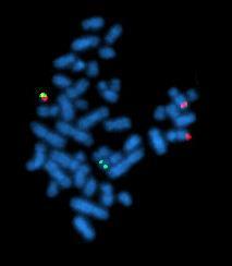 Glossario: esami diagnostici - Citogenetica: studio dell assetto cromosomico per individuare eventuali alterazioni cromosomiche (numero, traslocazioni, inversioni, delezioni) - Elettroforesi delle