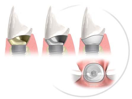 Questa componente può essere usata anche come supporto per la modellazione quando si preparano delle corone/ strutture che verranno poi scannerizzate per produrre delle protesi CAD/CAM o fresate al