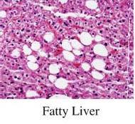 Natural history of NAFLD