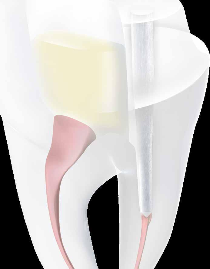 essere efficace il trattamento endodontico.