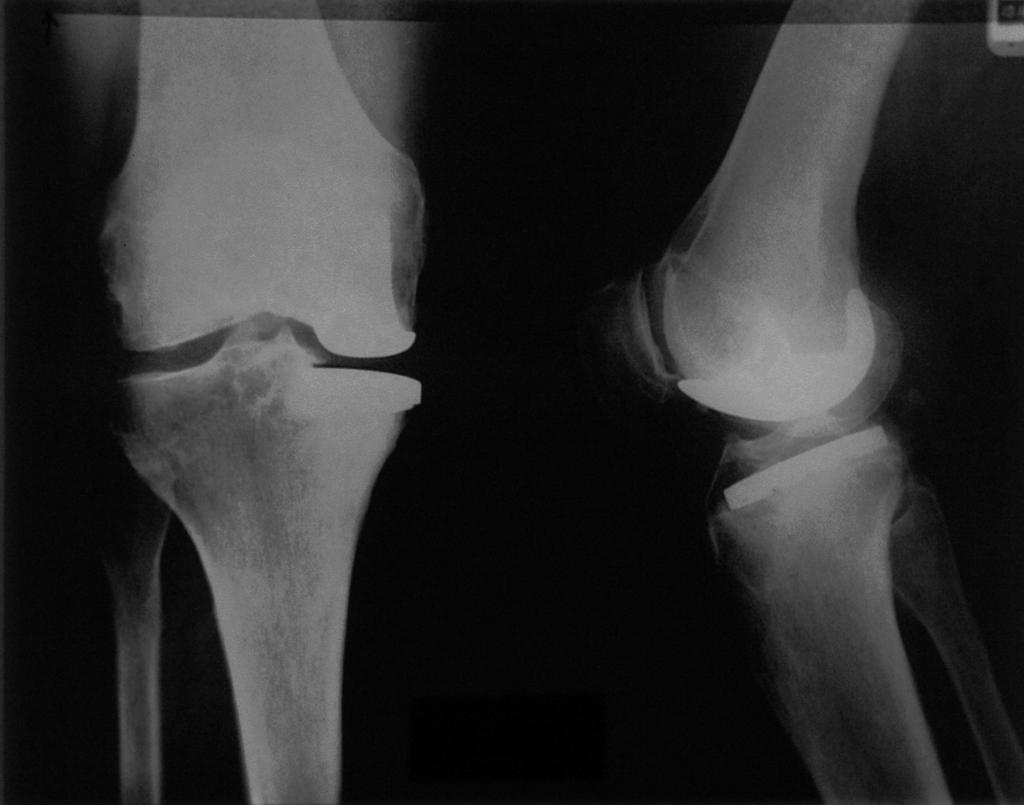 La protesi monocompartimentale di ginocchio nel trattamento del sovraccarico mediale Fig. 2. Paziente F.B., femmina, 69 anni. Mobilizzazione settica dell impianto a 1,5 anni. Fig. 3.
