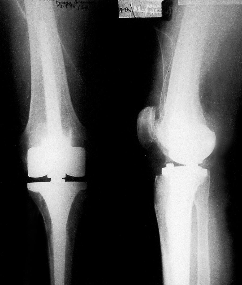 La protesi monocompartimentale si pone come soluzione chirurgica intermedia tra l osteotomia alta di tibia e la sostituzione protesica totale del ginocchio.