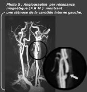 - Angiografia - Imaging radiografico non invasivo - angio TC e/o TC spirale - angio RMN La scelta dei valori dei criteri velocimetrici per definire la stenosi carotidea sono vari e nell ultimo