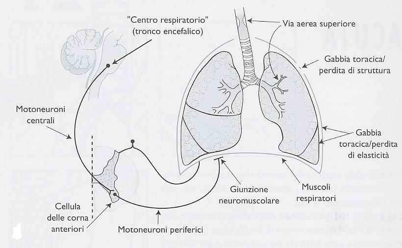 Insufficienza respiratoria ipercapnica ( insufficienza( del mantice ) Caratteri Malattia che interessa il comparto extrapolmonare Compromissione della ventilazione alveolare Acidosi respiratoria