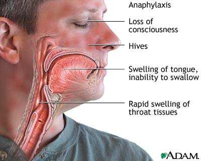 Sintomi e segni dell anafilassi sistemica Alte e basse vie aeree Angioedema Intraorale (15%) Totale : 69% broncospasmo (26%) edema della
