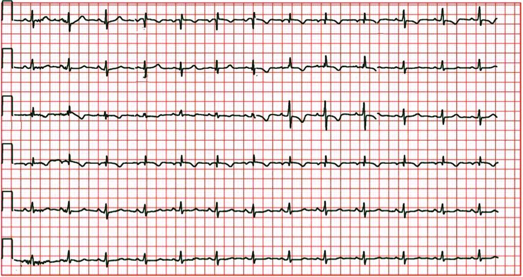 1780 Malattie del cuore, del pericardio e del circolo polmonare VIII I avr V1 V4 II avl V2 V5 III avf V3 V6 VI II V5 FIGURA 74.3 Elettrocardiogramma di un paziente con IPA.