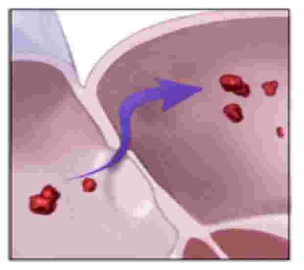 IL PFO E PATOLOGICO? SHUNT DX?