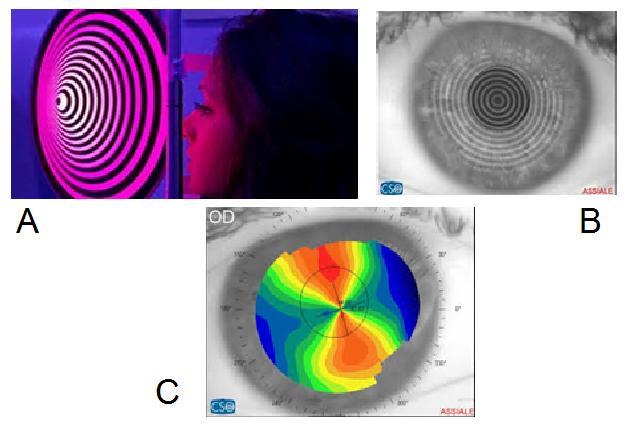 radiale della superficie corneale sono rappresentati da una serie di mappe cromatiche che seguono una scala di colori sviluppato dalla University of Louisiana [8]: le parti più piatte sono