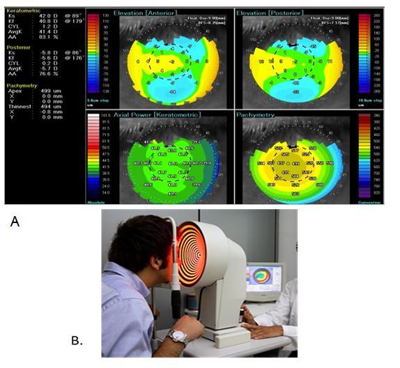 Fig. 16: (A) Tomografia corneale con rappresentazione delle mappe di curvatura ed