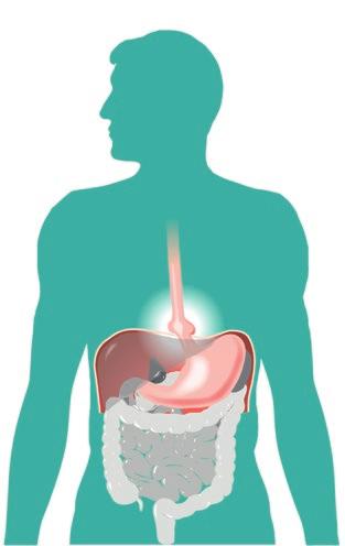 CONSEGUENZE Esofagite da reflusso: bruciore e infiammazione cronici del tratto inferiore