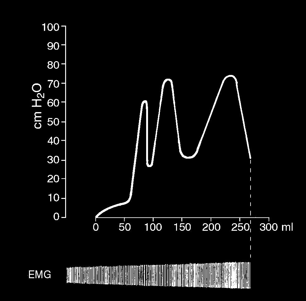 Figura 7 Cistometrogramma di detrusore iperreflessico eseguito contemporaneamente ad elettromiogramma di uno sfintere "spastico".