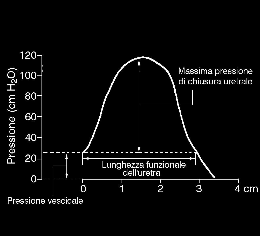 Figura 10 Rappresentazione grafica del profilo della pressione di chiusura uretrale registrato per punti successivi nell'uretra di una donna volontaria, sana.