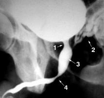 Figura 17 Cistouretrografia minzionale in soggetto maschile di 25 anni affetto da SM che presenta dissinergia vescico-sfinterale.