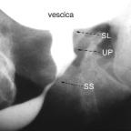 Figura 2 SL: Incompleta apertura dello sfintere liscio. UP: Dilatazione dell'uretra posteriore. SS: Ostruzione spastica dello sfintere striato. Radiografia eseguita in proiezione obliqua.