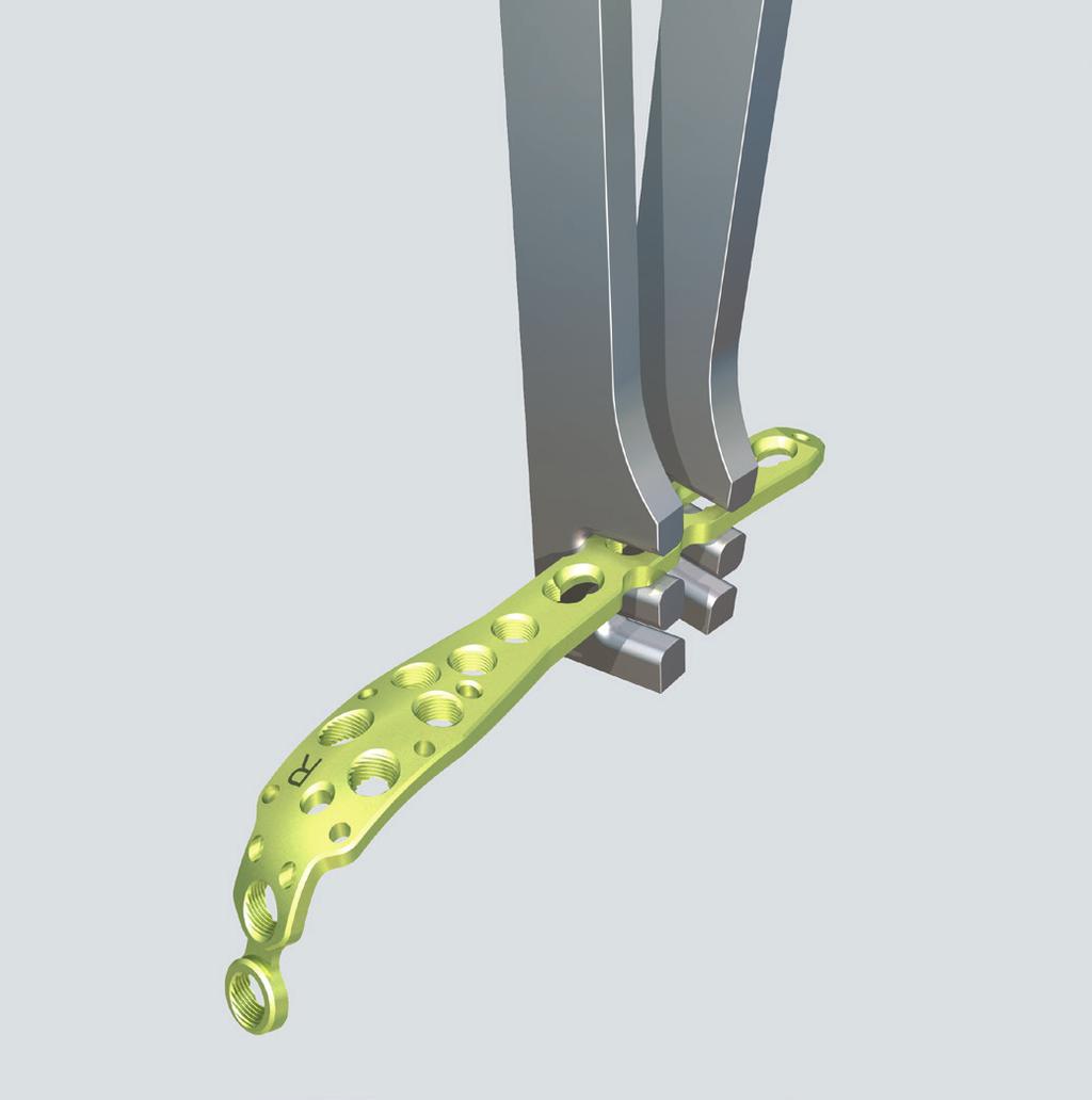 Impianto 4 Determinazione della lunghezza e adattamento della placca Strumenti necessari 329.150 Pinza piegaplacche da 2.4 a 4.0, lunghezza 230 mm oppure 329.