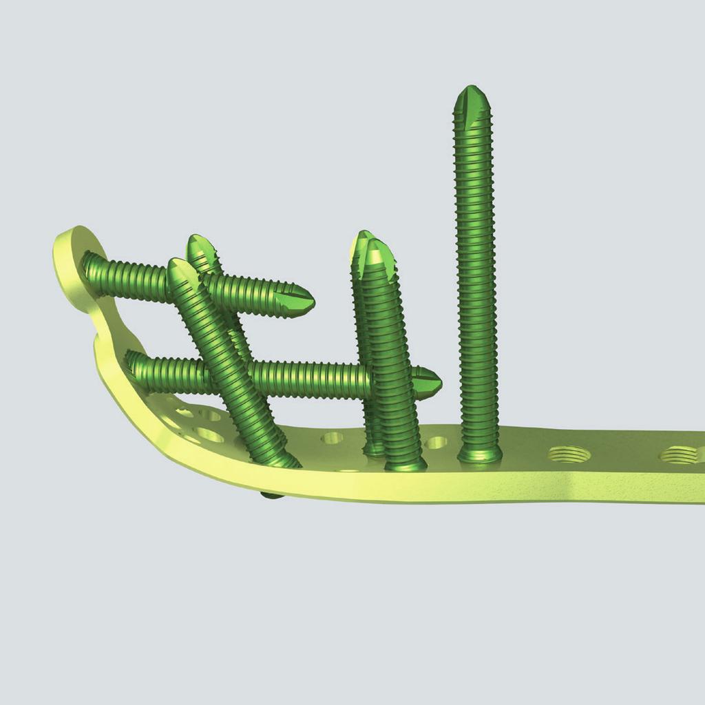 Impianto 6 Determinazione della lunghezza della vite per la parte prossimale Strumenti necessari 323.060 Misuratore di profondità PHILOS per filo di Kirschner da B 1.6 mm Alternativa 319.