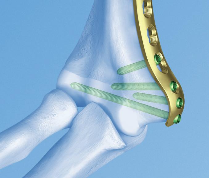 lunghezze: 3, 5, 7, 9 e 14 fori Anatomicamente premodellate: non è necessario il modellamento se non in minima parte, ampie opzioni di fissazione Blocco guida per un inserzione corretta Indicazioni