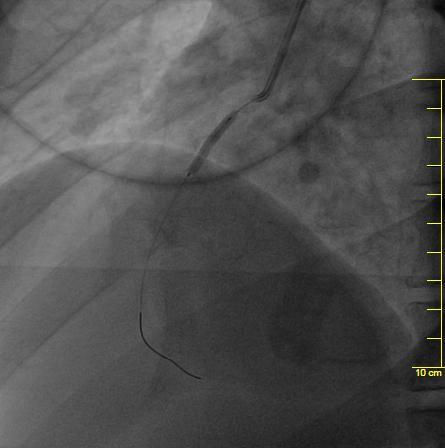 CASO CLINICO: ANGIOGRAFIA IN