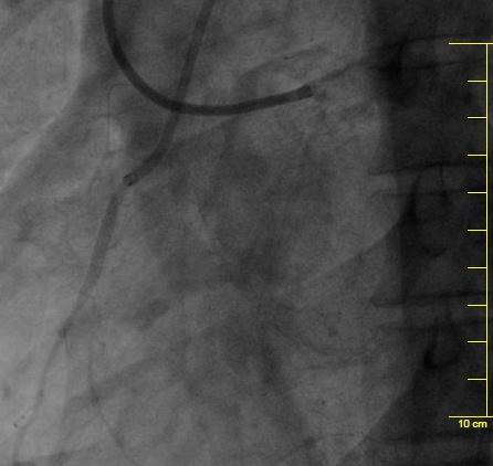 RCA- CTO: PLANNING PROCEDURALE JCTO: 2 (blunt, no calcification, bending > 45, short occlusion ) Presenza di