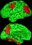 Dall accademia alla clinica Alzheimer Clinica: 2 fasi principali: - mild cognitive impairment (MCI, leggero disturbo cognitivo), che puo