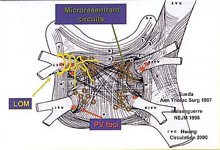 Substrato elettrico della fibrillazione atriale A livello della giunzione tra atrio sinistro e vene polmonari è presente una