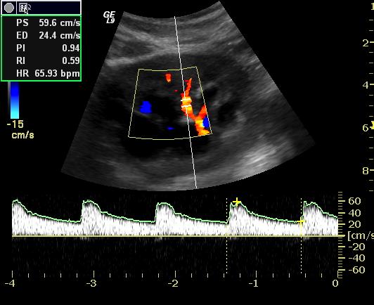 Fattori predittivi di progressione Indici di resistenza Radermacher J Hypertension, 2002 Splendiani C, Clinical Nephrology, 2002 Ikee R, Am J of Kidney