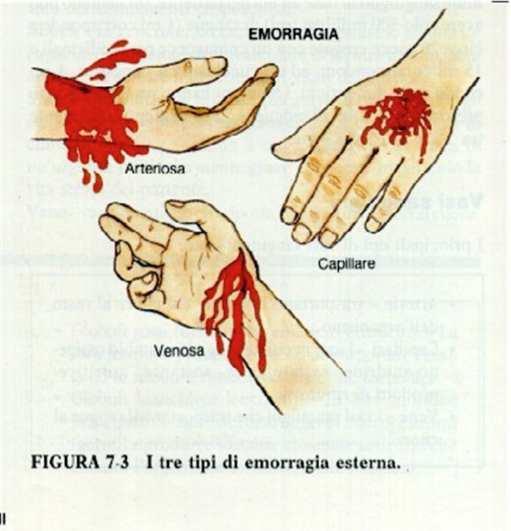 Emorragia Fuoriuscita di sangue da uno o piùvasi sanguigni.