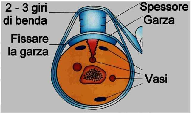 Fasciatura compressiva Garza